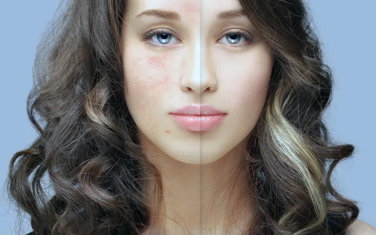 A woman showcasing her skin before and after acne treatment, highlighting the improvement in her complexion.
