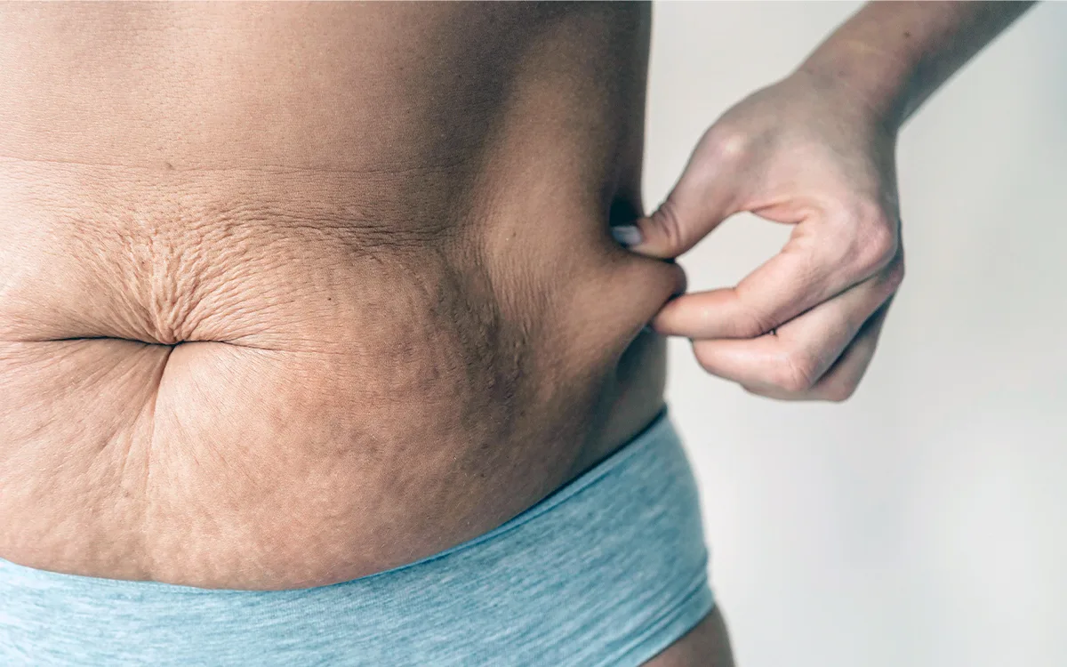 A woman showcasing a large belly and small waist, highlighting the common issue of loose skin following weight loss.