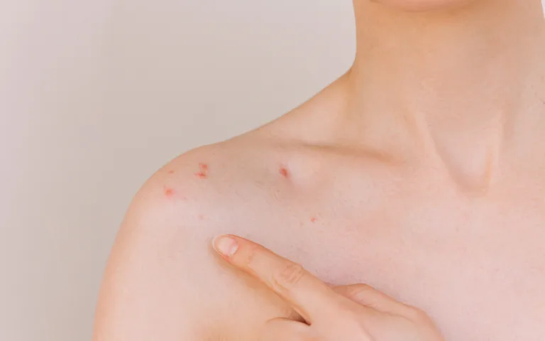 A woman showing a small patch of skin on her chest, highlighting the topic of acne and diet myths for better skin health.