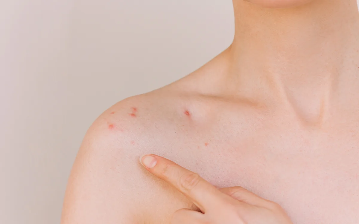 A woman showing a small patch of skin on her chest, highlighting the topic of acne and diet myths for better skin health.