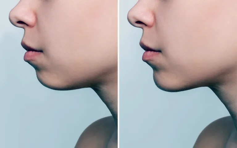 Side-by-side images of a woman's face, illustrating the reduction of her double chin and enhanced jawline after exercises.