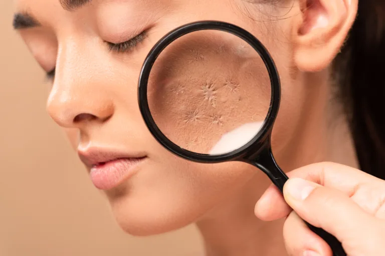 Close-up of facial skin viewed through a magnifying glass, showing dryness and texture changes often linked to imbalanced glucose levels.