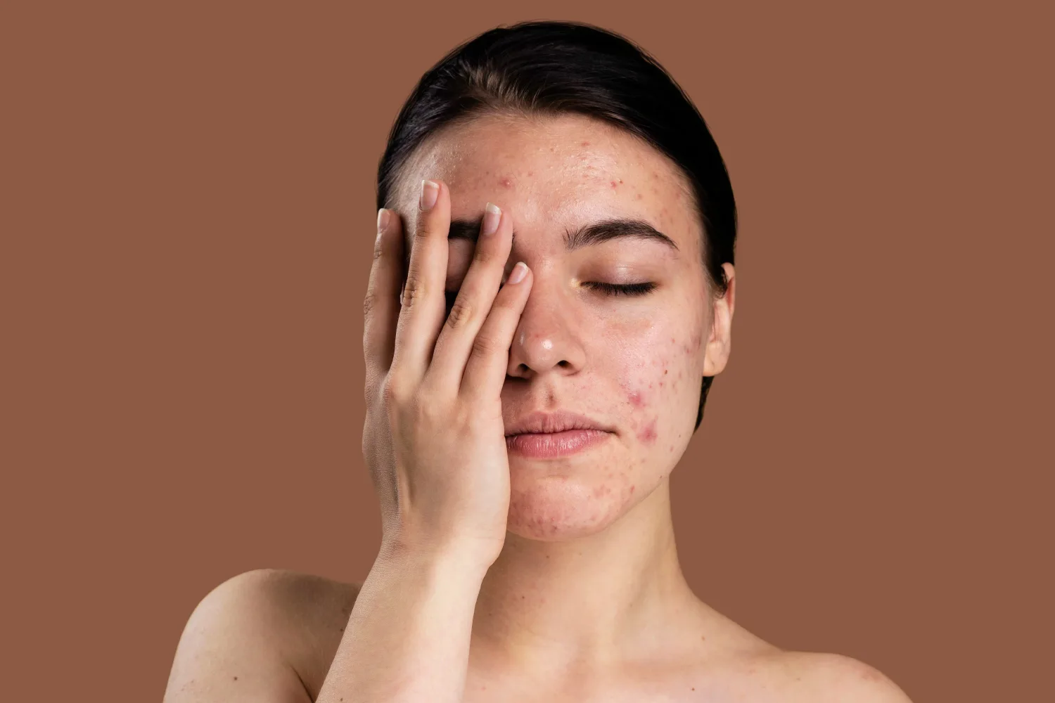 woman with acne and inflamed skin showing common skin issues that zinc may help support